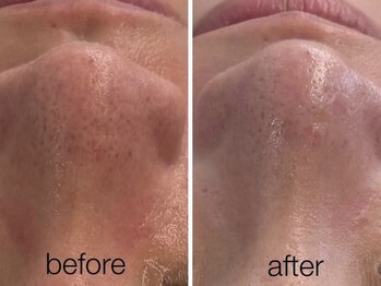 リスポアラボ(LIS PORE.LAB)/1回BeforeAfter