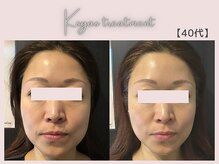 美シェリ(美Cheri)/小顔矯正ビフォーアフター