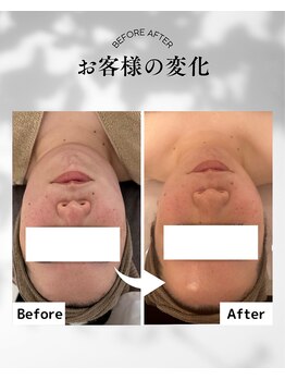 エムボーテ 太田店(M BEAUTE33)/顔筋小顔コルギ