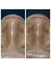 ビーサロン(B-salon)/男性にも◎3D毛穴洗浄