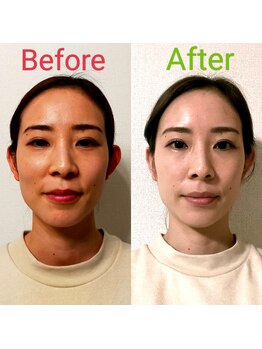 シャルム(Charme)/小顔矯正１回