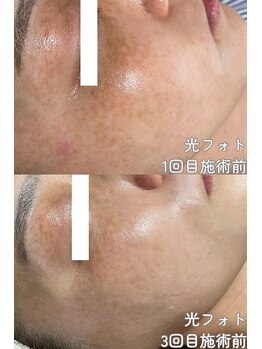 クレアナ ザ ビューティー(KULEANA the beauty)/光フォト