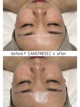 ベルティーク(BELTHEQUE)/アンストレス＋光フェイシャル