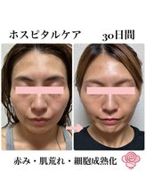 ケンビラク(Kenbiraku 健美楽)/赤み・肌荒れ・細胞成熟化　30日