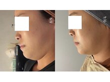 ピナリ(PINARI)/レモンボトル