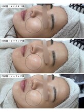 ソワナ(soina)/【神楽坂駅/フェイシャル/毛穴】