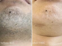 脱毛専門サロン エリクサー(Elixir)の雰囲気（メンズ脱毛圧倒的人気No.1♪リピート率98%のヒゲ脱毛！）