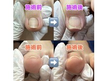 なべ整骨院の雰囲気(深爪(陥入爪)の症例♪ブログにてさらに詳しく紹介しています◎)