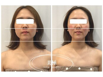 美極 銀座店/銀座/小顔コルギ/小顔矯正