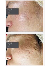 マリーローラン メンズルイズ(Marryrolan MensRuise)/ハーブピーリング施術前・後