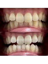 ハリス(HARIS)/セルフホワイトニング