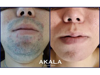 メンズ脱毛サロン アカラ(AKALA)/ヒゲのビフォーアフター