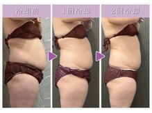 アモ(AMO)の雰囲気（痩身脂肪冷却。代謝が良くなりリバウンドしない体へ※男性OK）