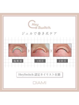 ネイルリテルナ(Nail Re.terna)/巻き爪ケア