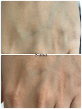 サナ 久が原 千鳥町(S’ana)/ルビッシュ照射