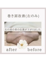 アリサナ(Arisana)/症例写真　巻き肩調整　