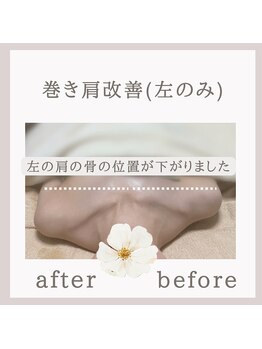 アリサナ(Arisana)/症例写真　巻き肩調整　