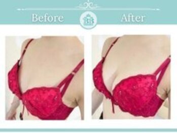 ベルビューティー(belle beauty)/【サイズアップ/C以下】症例写真