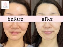 サクラ(SAKURA)/30代前半　透明感はエアバリ