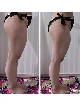 アイナ(aina)/マシーンと手技でトリートメント