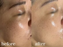 フェイシャルサロン アリイ(ALII)の雰囲気（最先端の肌質別ピーリングや毛穴洗浄で肌管理！）