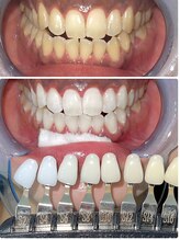ココホワイトニング 天王寺店/ビフォーアフター４