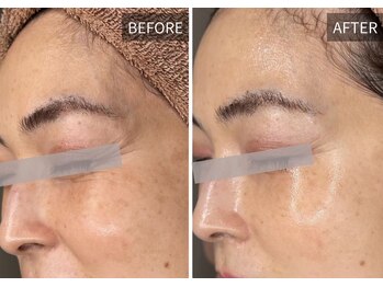 エナ(ENA)/ララピール ゴワつき×毛穴ケア