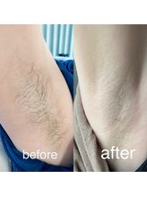 エステサロン ソワン/脇のBeforeAfter
