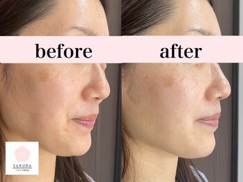 サクラ(SAKURA)/1回でこの効果やっぱりエアバリ