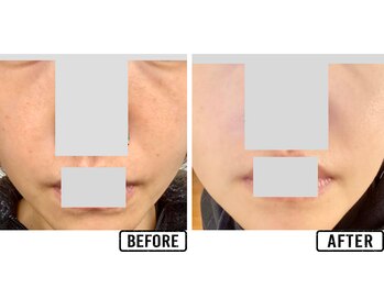 毛穴屋/頬の毛穴開きも★