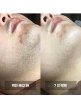 リムル(REMURU)/ひげ脱毛7回照射