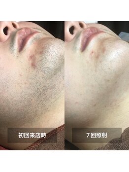 リムル(REMURU)/ひげ脱毛7回照射