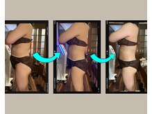 アムスパ(Aum Spa)/お腹周り脂肪分解液導入3回