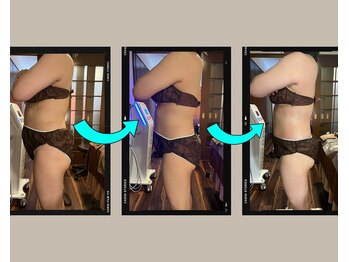 アムスパ(Aum Spa)/お腹周り脂肪分解液導入3回