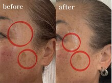 エピリス(Epiliss)/シミ、目尻しわビフォーアフター