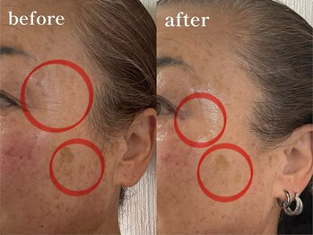 エピリス(Epiliss)/シミ、目尻しわビフォーアフター