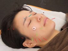 八軒さきがけ鍼灸整体院/美容鍼灸