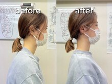 ニューカイロプラクティック カネヨシ/頚椎矯正のビフォーアフター