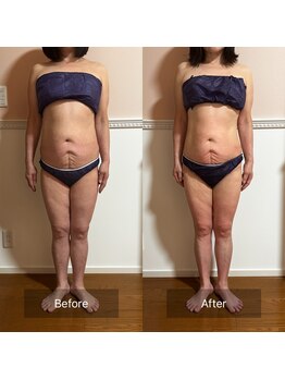 トータル フィルシャイン(Total Fillshine)/全身痩身6回