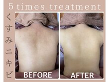 ハーブピーリング 恵比寿の雰囲気(全身ケア可能なハーブピーリングで背中やヒップも人気!)