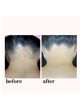 カウピリ(kaupili)/【脱毛】ビフォーアフター