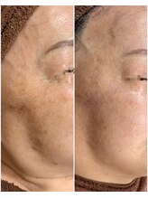 ラヴィオス 渋谷表参道店(RAVIOS)/肌質改善 ハーブピーリング全顔