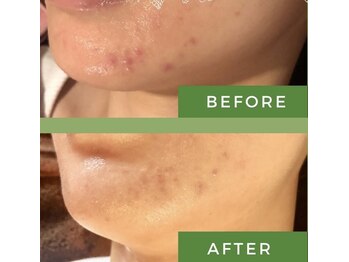 ミミー/繰り返していた顎ニキビが改善