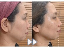 エステティックサロン フェリス(Aesthetic salon FELIZ)の雰囲気（ラミネーションピール【シワ/たるみ/毛穴】改善して艶々水光肌へ）