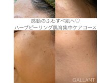 ギャラント(GALLANT)の雰囲気（衝撃の透明感！敏感肌質改善ハーブピーリング思春期ニキビも◎）