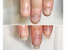 グラシュータン(gracieux temps)/深爪矯正