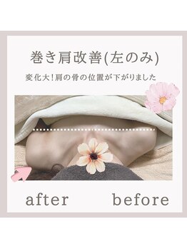 アリサナ(Arisana)/症例写真　巻き肩調整　