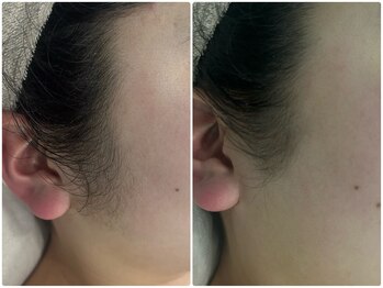 シェリアン バイ アイビー(Cherien by IVY)/ワントーンUP顔脱毛