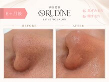 オルディーネ(ORUDiNE)/ 黒ずみ毛穴改善