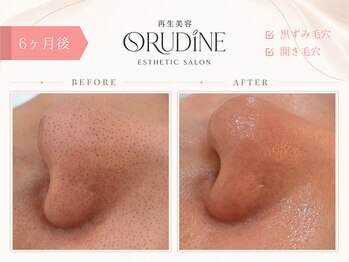 オルディーネ(ORUDiNE)/ 黒ずみ毛穴改善